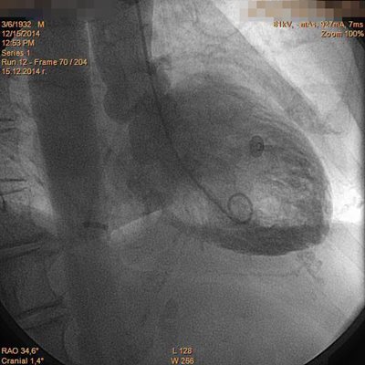 Ангиографски снимки на сърцето и излизащата от него аорта на пациентка с Такоцубо синдром, описана от доц. Марчев. Вляво сърцето е между две съкращения (диастола), а вдясно - по време на съкращение (систола). Сърцето приема формата на делва с тясно гърло и широко тяло по време на съкращение. СНИМКИ: АРХИВ НА ДОЦ. СОТИР МАРЧЕВ