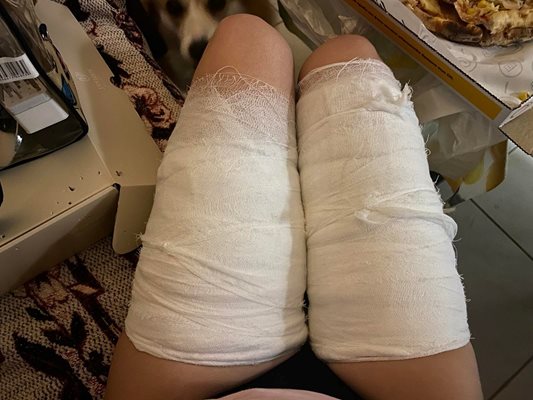 Краката на Дияна Плачкова, бинтовани след приемането й в болница СНИМКА: Личен архив