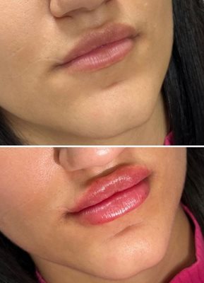 Устните й преди и след интервенцията