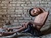 13-годишно индийче оперира врата си, изкривен на 180 градуса