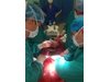 Извадиха 15 кг тумор от корема на жена в Пловдив