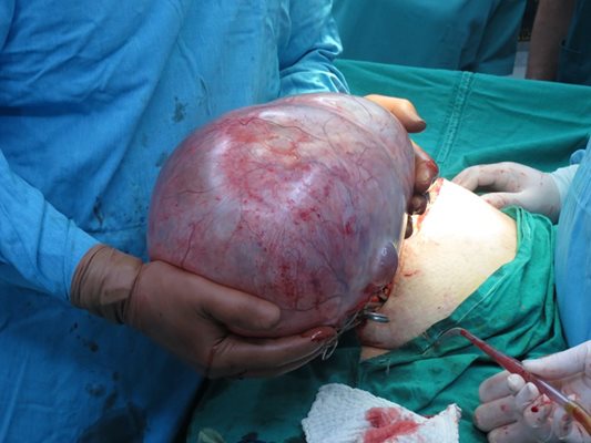 Огромната 9-килограмова киста на яйчника, извадена от корема на жената