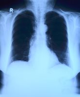 Франция отчита ръст на заразени с туберкулоза през 2023 г. СНИМКА: Pixabay