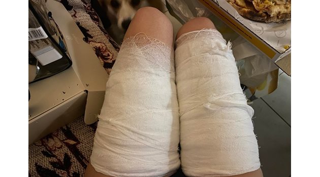 Краката на Дияна Плачкова, бинтовани след приемането й в болница СНИМКА: Личен архив