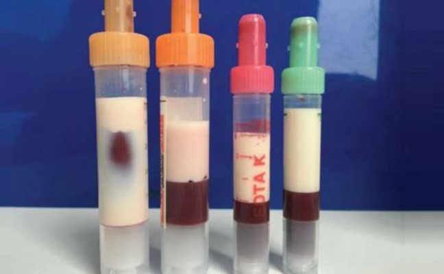 Кръвни проби на кьолнския пациент в хода на прочистването му от мазнини