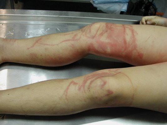 Изгаряне, причинено от пурпурните медузи
