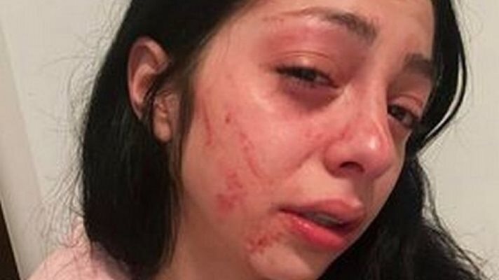Бившата приятелка на Васил - Боряна, показа нараненото си лице в социалната мрежа.

СНИМКА: ФЕЙСБУК