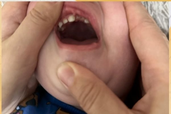 Зъбът на детето е счупен. Кадър: Nova