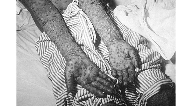 Болен показва ръцете си, след като е бил заразен.