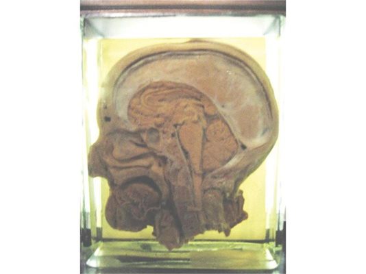 Тази глава на човек, екзекутиран във Франция преди 200 г., трябвало да докаже, че мозъкът на престъпника е по-различен.