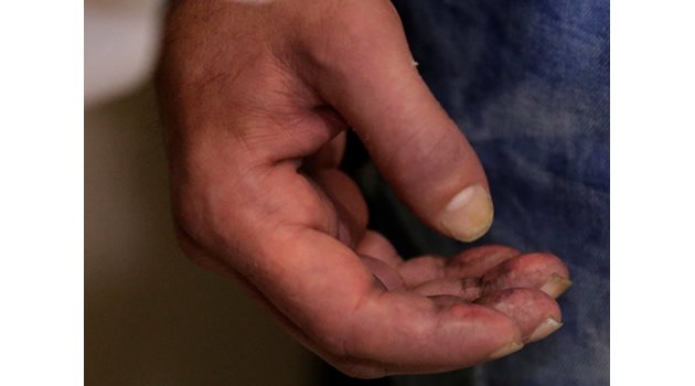 Лекарите наричат покривната тъкан на пръстите незаменима кожа.