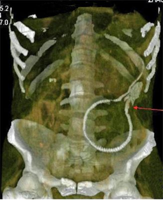 Мъж хакна в задника си 50-сантиметрова жива змиорка