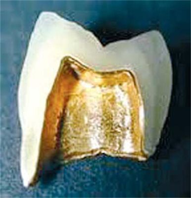 1. Златото се слага отвътре на коронките.