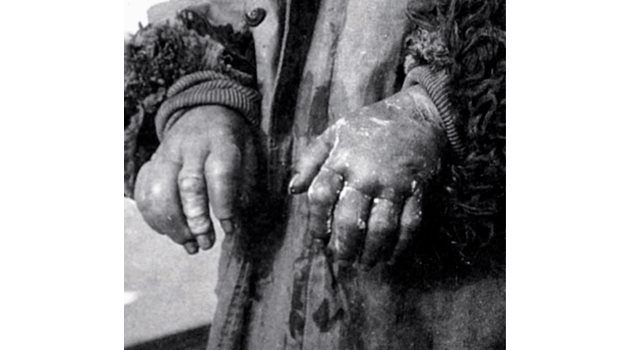Измръзналите ръце на китайско дете, което беше изведено през зимата от персонал на отдел 731 за експеримент за това как най-добре да се лекуват измръзванията.