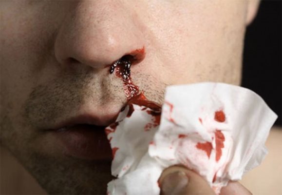 Спрете лесно честото шуртене на кръв от носа