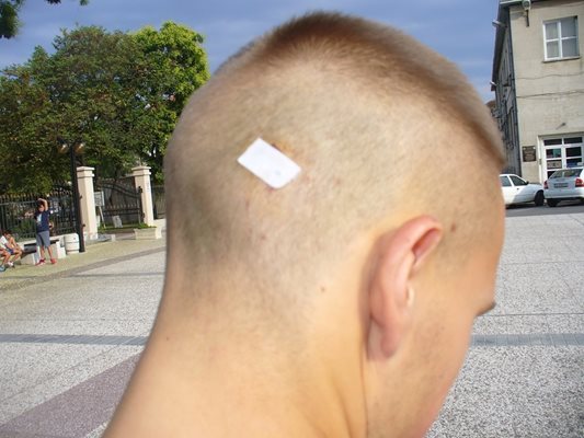 През юли т.г. удареният Д. С. показа раната на главата си пред "24 часа".  Снимка: Ваньо Стоилов