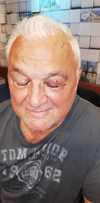 Сашо Диков с наранено око. Фотограф: Виктория Цветкова