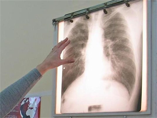 12 области са с тревожно високи нива на заболели от туберкулоза