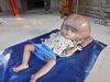 Почина индийското момиченце, което трогна света с огромната си глава (Видео и снимки)