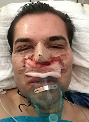Операция на носа може да убие Алвес