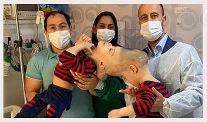 Лекари разделиха сиамски близнаци с технология, използваща виртуална реалност (Снимки)