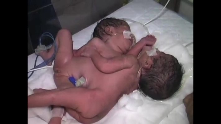 Сиамските близнаци могат да се окажат златна мина за родителите