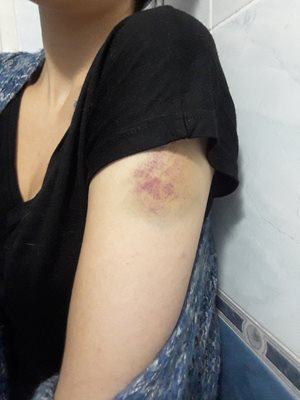 Диана Димитрова имала хематом и на ръката след побоя.
СНИМКА: ФЕЙСБУК