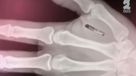 Американец си имплантира безжични чипове в ръцете (видео)