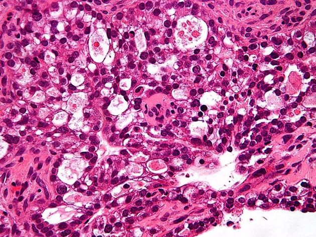 Ракови клетки в матката, които се повлияват от лечението.