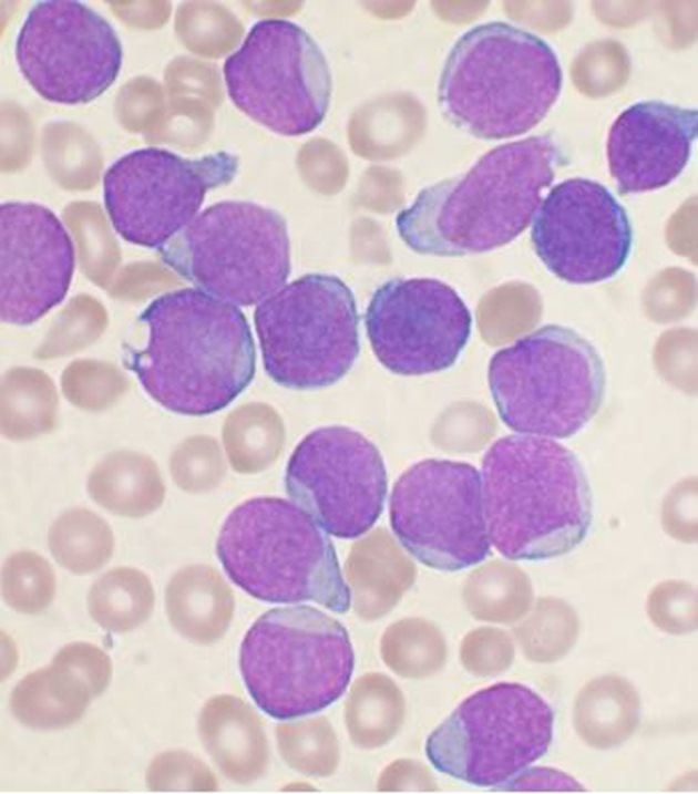 Левкемия - туморните клетки са оцветени в лилаво.