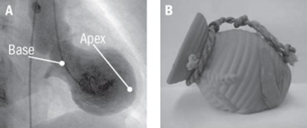 Издута лява сърдечна камера (вляво) и гърне за октоподи (вдясно).