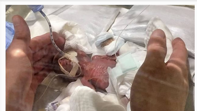 Момченце, с тегло едва 258 грама, се роди в Япония, изписват го от болницата
