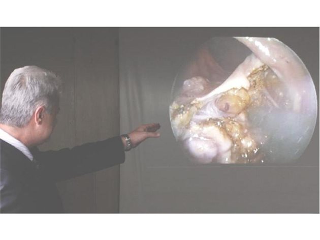 Д-р Гърбев демонстрира как се изрязва болна тъкан от ректума с ендоскопския метод. 
СНИМКИ: КРИСТИНА ЦВЕТКОВА 
