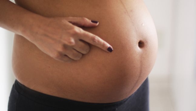 Какво означава тъмната линия по корема през бременността