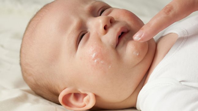 Бебешкото акне е по-разпространено при момченцата