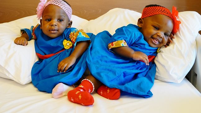 Сиамски близнаци разделени след сложна 27-часова операция в Acibadem Турция