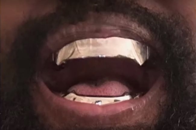 Американският рапър Кание Уест извади всичките си зъби Кадър: Нова тв