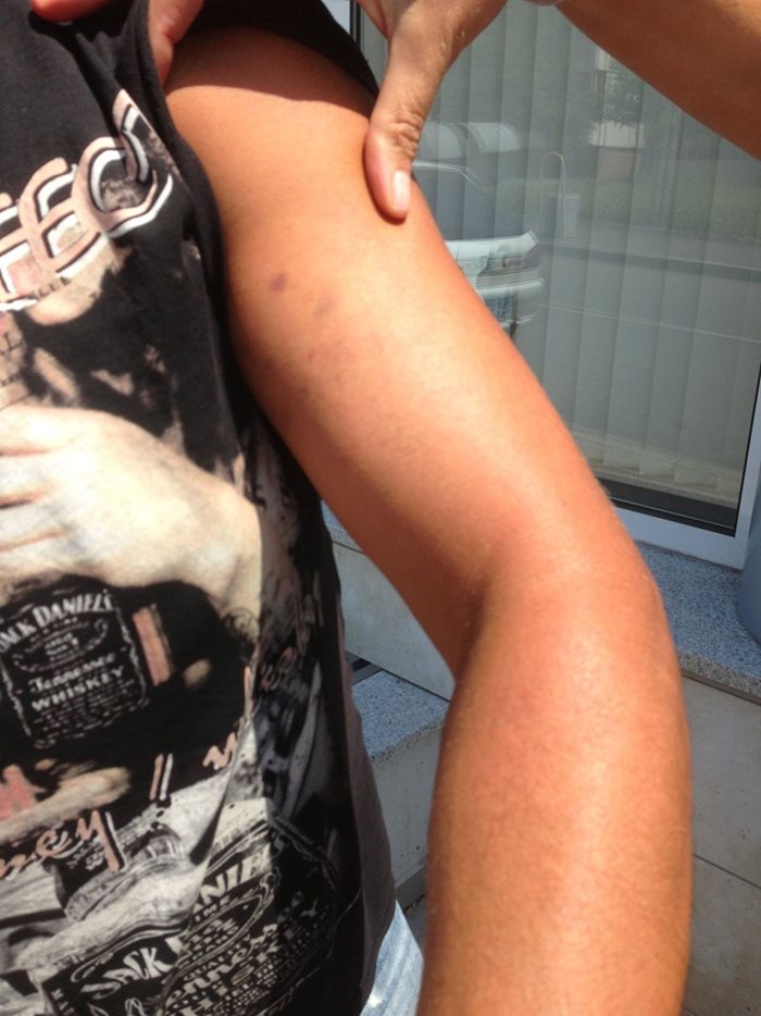 Синини по лявата ръка на Мишел Камполо, описани в медецинското му от столична болница. Снимка: Авторът