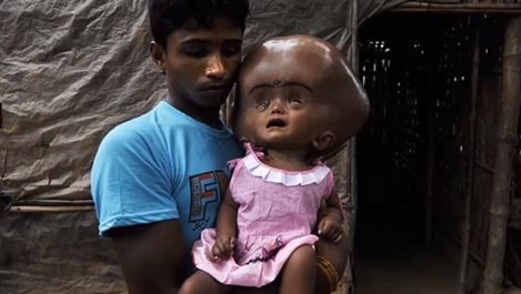Почина момиченцето, което трогна света с огромната си глава (Видео и снимки)