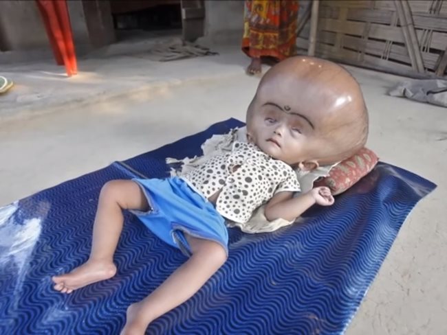 Индийското момиченце Руна Бегум, страдащо от рядко заболяване, заради което главата му беше два пъти по-голяма. Кадри: YouTube/Teletechnology