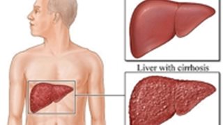 Какво се случва, когато черният дроб и жлъчката не функционират правилно