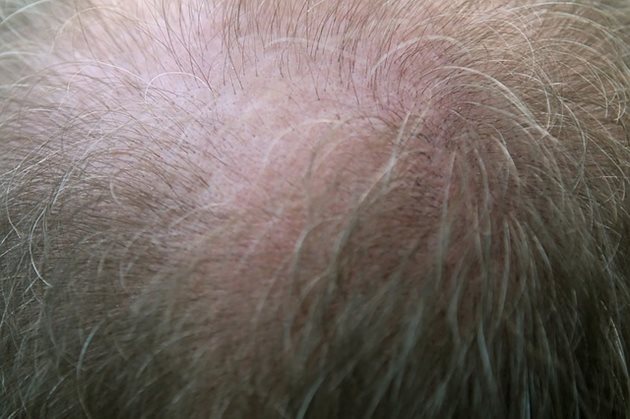 Експертите активираха стволовите клетки в космения фоликул, които отговарят за растежа на косата. СНИМКА: Pixabay
